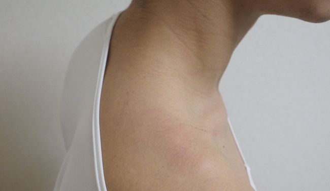 その日の夜、肩にはくっきりとダメージが。

